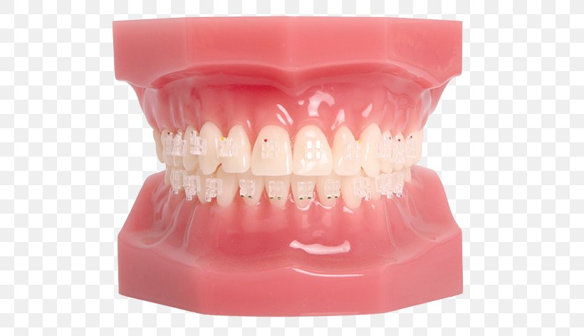 Tooth Dental Braces Orthodontics Splint Maxilla, PNG, 540x472px, Tooth, Bruxism, Dental Braces, Jaw, Maxilla Download Free