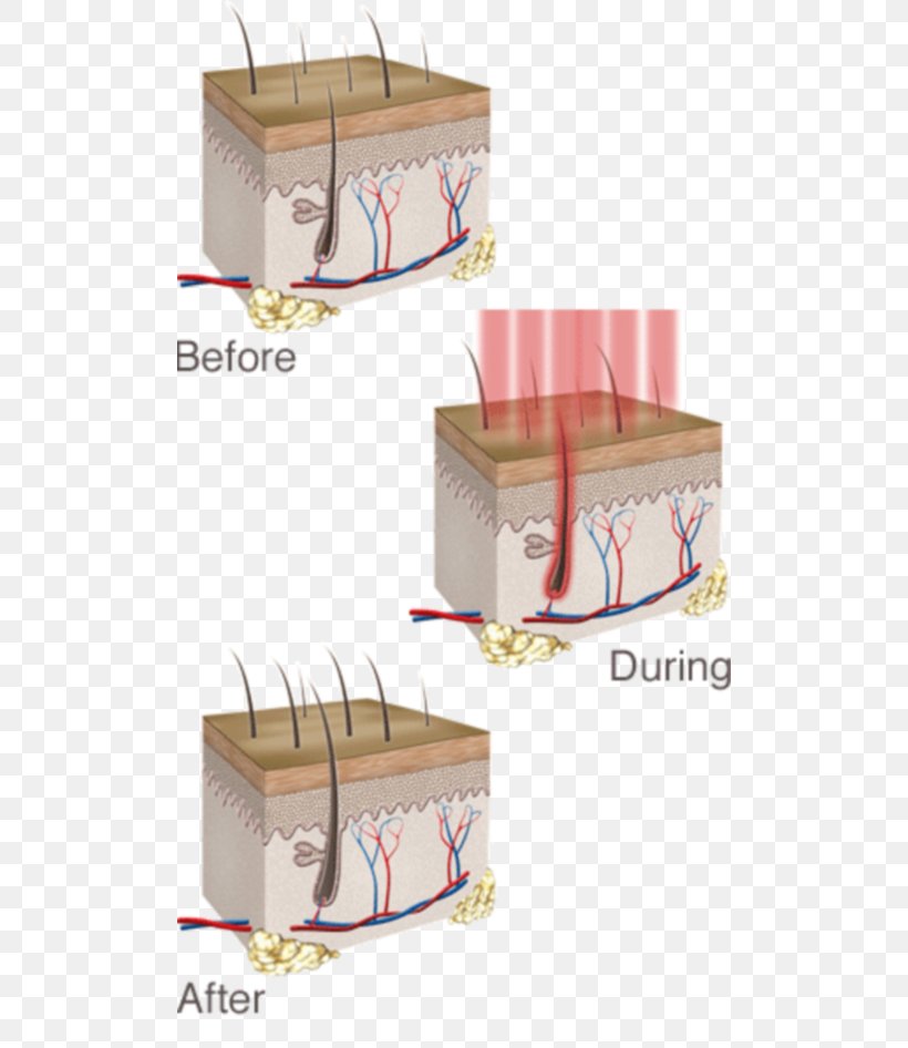 Low-level Laser Therapy Management Of Hair Loss, PNG, 500x946px, Lowlevel Laser Therapy, Box, Carton, Hair, Hair Care Download Free