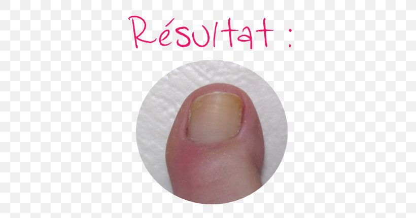 Nail Foot Cuticle Cuticule Onychomycosis, PNG, 650x430px, Nail, Cuticle, Cuticule, Finger, Foot Download Free