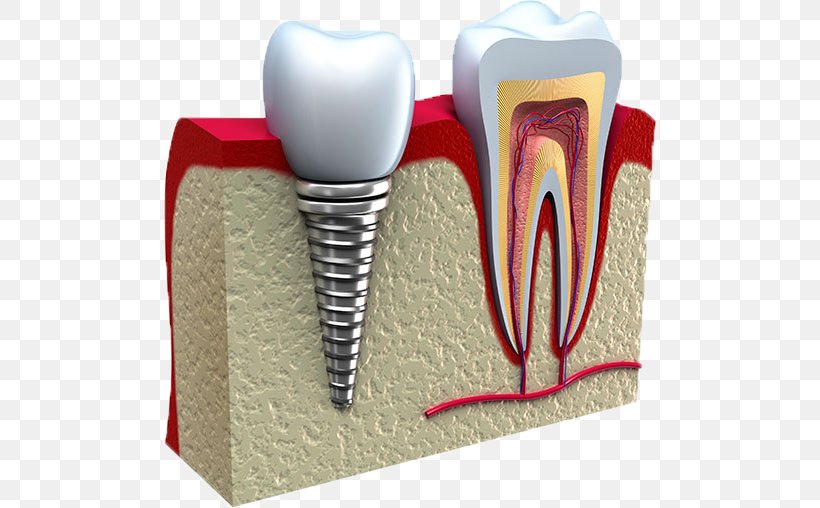 Dental Implant Dentistry Tooth, PNG, 519x508px, Watercolor, Cartoon, Flower, Frame, Heart Download Free