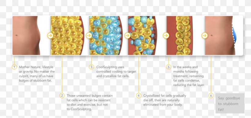 Cryolipolysis Adipocyte Adipose Tissue Surgery Cell, PNG, 1501x709px, Cryolipolysis, Abdomen, Abdominal Obesity, Adipocyte, Adipose Tissue Download Free