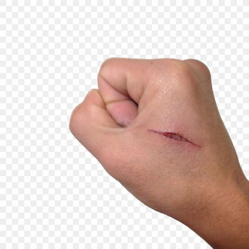 Hand Thumb Scar, PNG, 2000x2000px, Hand, Arm, Cheek, Chin, Finger Download Free