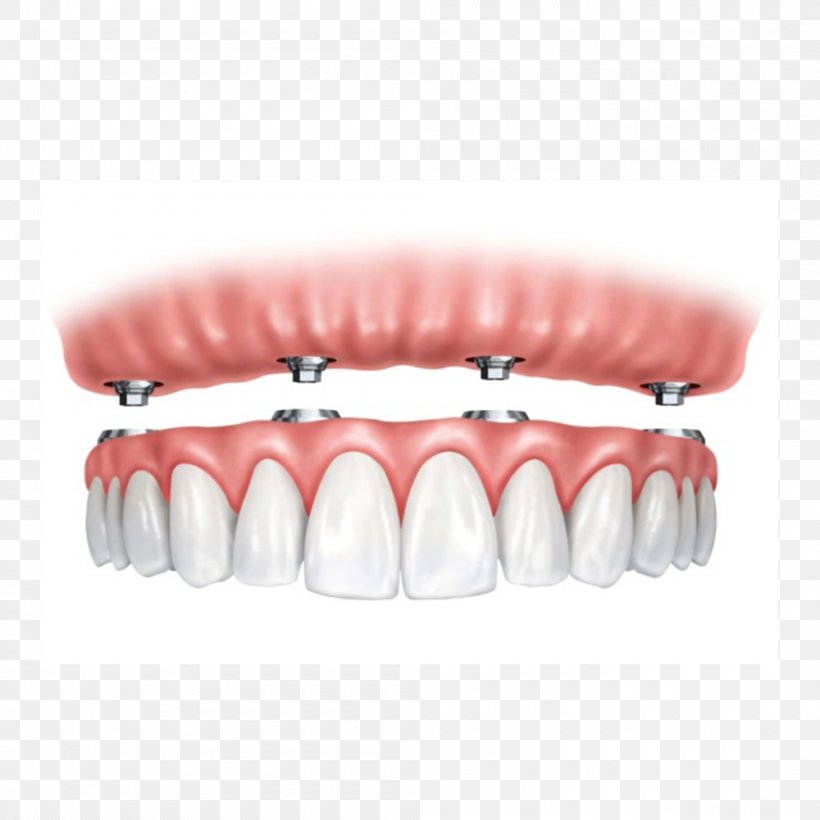All-on-4 Dental Implant Dentures Dentistry, PNG, 1000x1000px, Dental Implant, Dentistry, Dentures, Edentulism, Health Download Free
