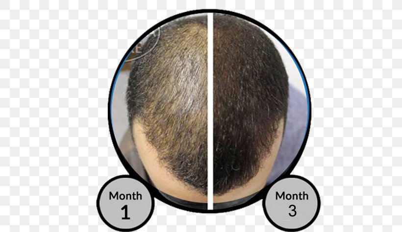Toppik Hair Building Fibers Hair Loss Forehead, PNG, 577x474px, Hair, Brown Hair, Building, Chin, Dietary Supplement Download Free