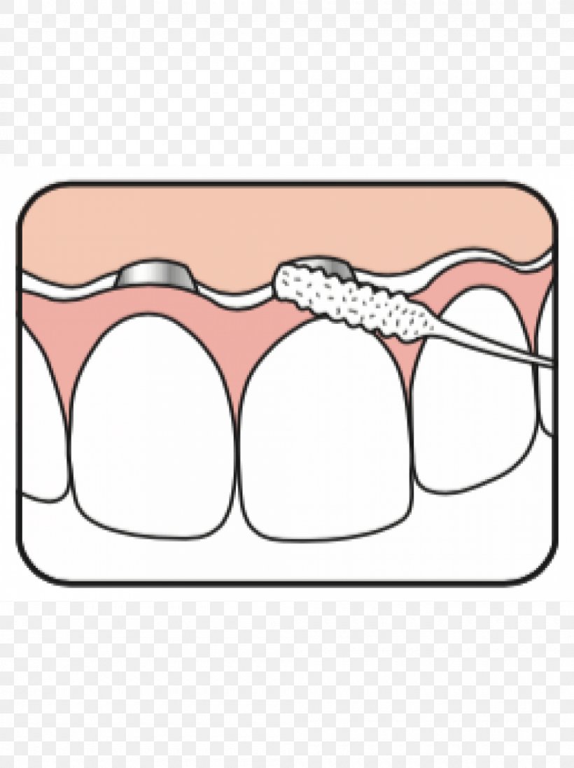 Tooth Dental Floss Dentistry Jaw Mouth, PNG, 1000x1340px, Watercolor, Cartoon, Flower, Frame, Heart Download Free