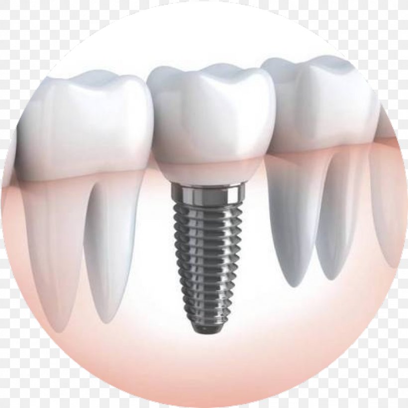 Dental Implant Dentistry Dentures, PNG, 1024x1024px, Watercolor, Cartoon, Flower, Frame, Heart Download Free