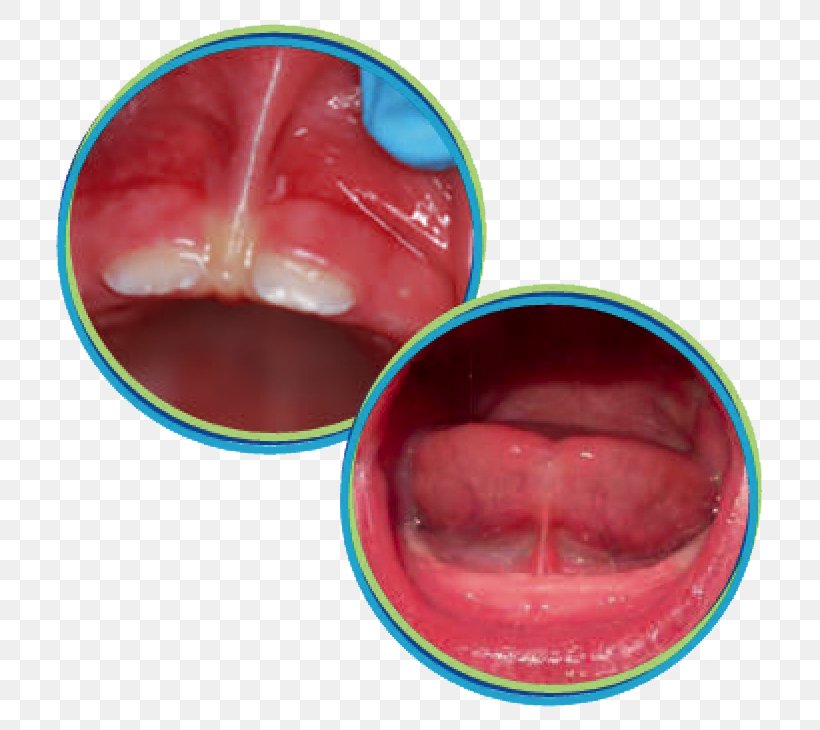 Ankyloglossia Lip Frenectomy Tongue Mouth, PNG, 730x730px, Ankyloglossia, Breastfeeding, Child, Dentist, Dentistry Download Free