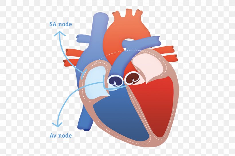 Heart Subcutaneous Implantable Defibrillator Cardiac Arrest Sudden Cardiac Death Implantable Cardioverter-defibrillator, PNG, 1440x960px, Watercolor, Cartoon, Flower, Frame, Heart Download Free