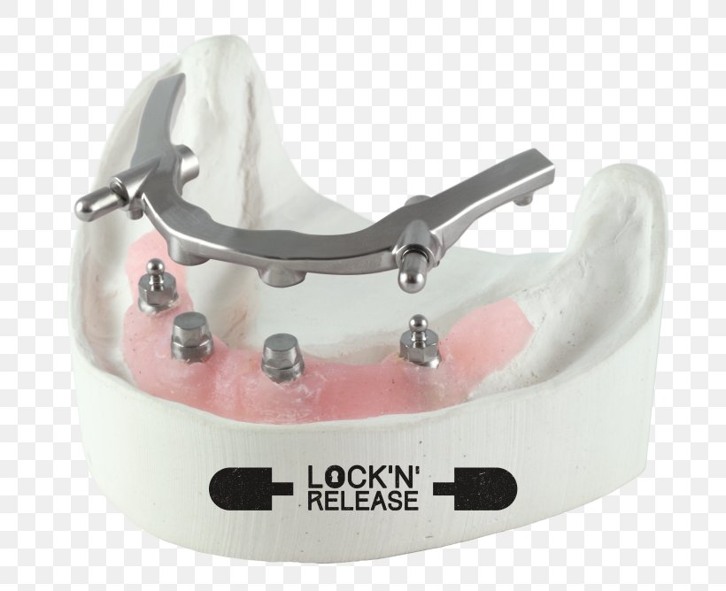 Dental Implant Dental Laboratory Jaw CAD/CAM Dentistry, PNG, 800x668px, Implant, Aesthetics, Cadcam Dentistry, Ceramic, Cerec Download Free