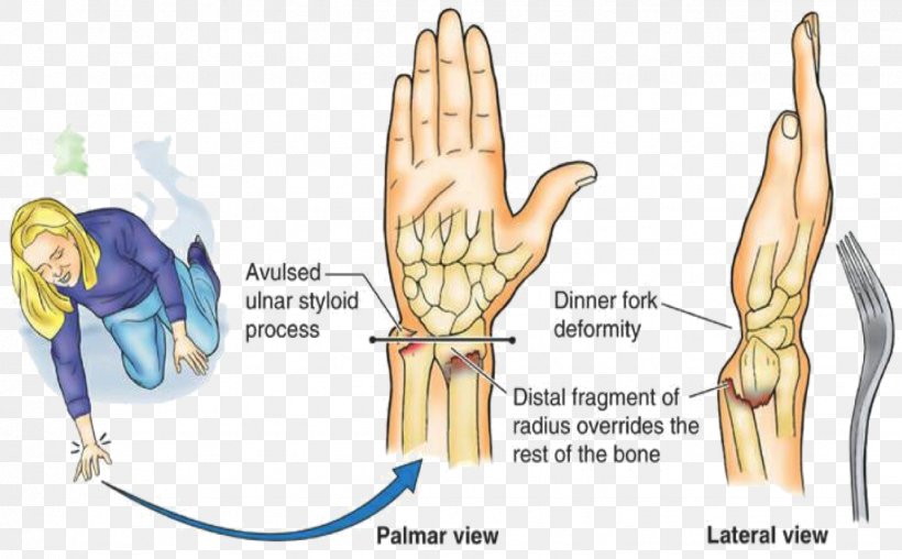 Colles' Fracture Distal Radius Fracture Smith's Fracture Physical Therapy Bone Fracture, PNG, 1336x829px, Watercolor, Cartoon, Flower, Frame, Heart Download Free