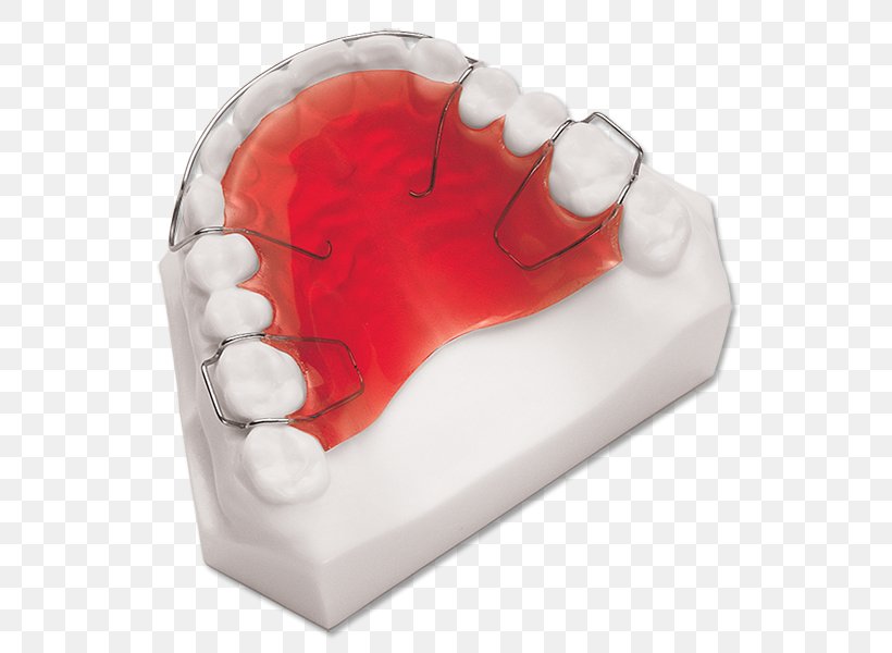 Retainer Orthodontics Dentistry Dental Laboratory, PNG, 556x600px, Retainer, Clear Aligners, Dental Braces, Dental Implant, Dental Laboratory Download Free