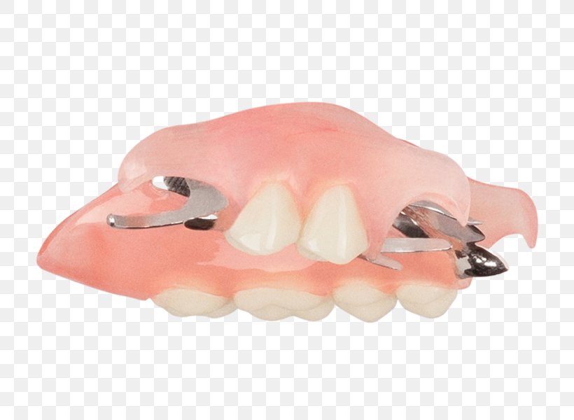 Tooth Dentures Removable Partial Denture Dentistry Crown, PNG, 749x600px, Tooth, Aspen Dental, Blog, Creative Commons License, Crown Download Free