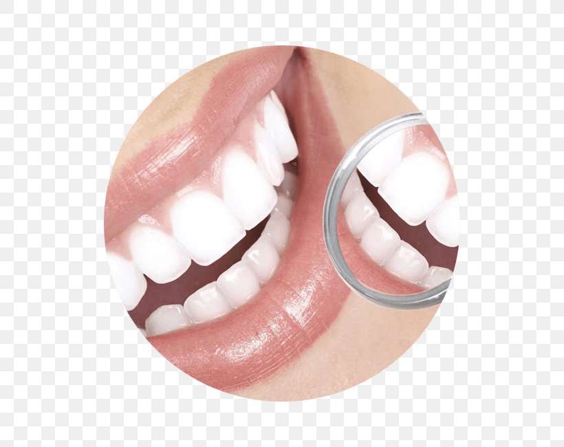 Cosmetic Dentistry Tooth Periodontology, PNG, 650x650px, Dentistry, Clear Aligners, Cosmetic Dentistry, Crown, Dentist Download Free