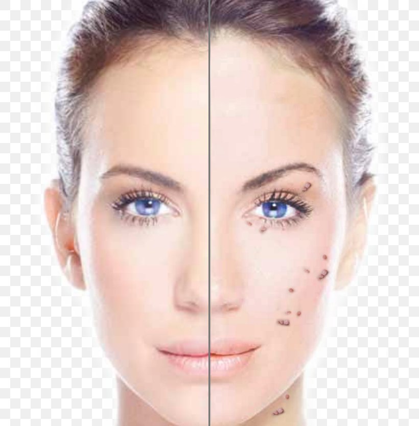 Laser Collagen Induction Therapy Skin Exfoliation Chemical Peel, PNG, 700x834px, Laser, Acne, Beauty, Cheek, Chemical Peel Download Free
