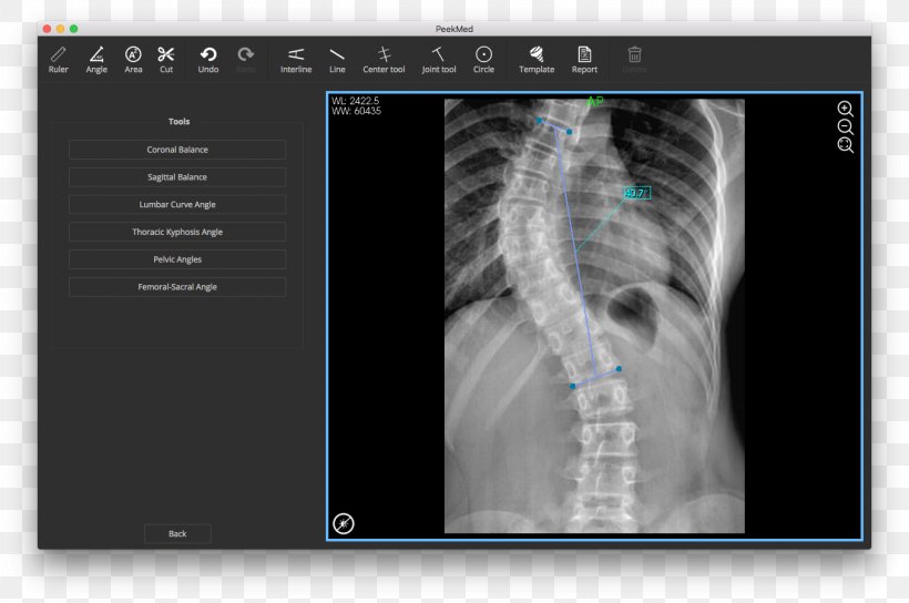 Scoliosis X-ray Vertebral Column Radiography Physical Therapy, PNG, 2712x1802px, Scoliosis, Bone, Bruise, Chiropractic, Injury Download Free