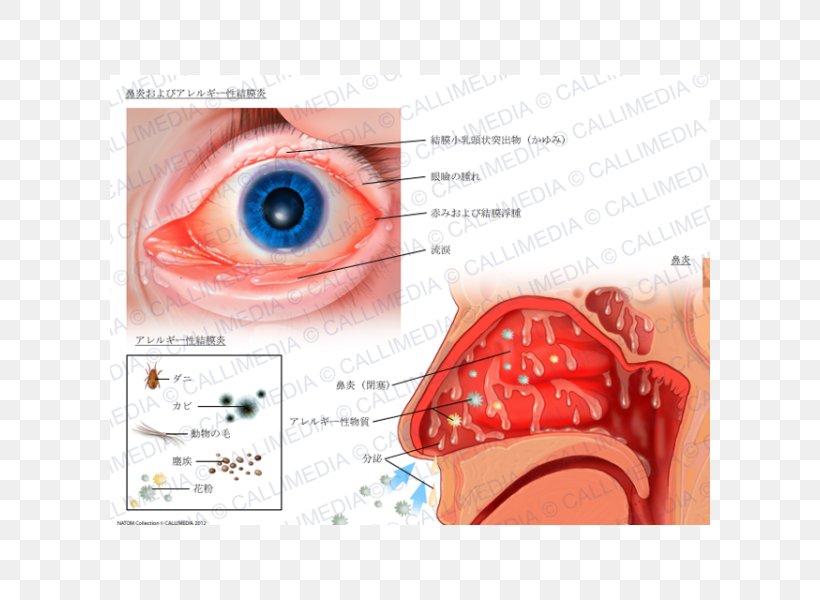Allergic Conjunctivitis Hay Fever Rhinitis Allergy, PNG, 600x600px, Watercolor, Cartoon, Flower, Frame, Heart Download Free