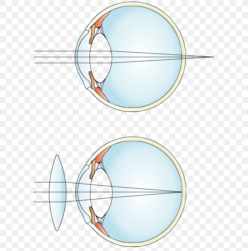 Hypermetropia Near-sightedness Lens Eye Glasses, PNG, 600x829px, Hypermetropia, Area, Contact Lenses, Cornea, Corrective Lens Download Free