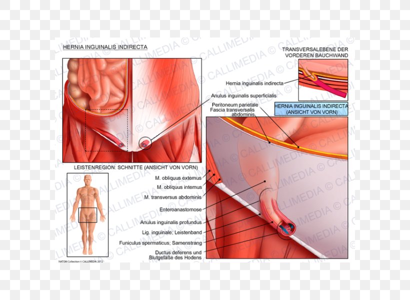 Inguinal Hernia Abdominal External Oblique Muscle Inguinal Canal Abdominal Internal Oblique Muscle, PNG, 600x600px, Watercolor, Cartoon, Flower, Frame, Heart Download Free