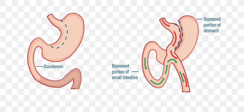 Duodenal Switch Bariatric Surgery Duodenum Gastric Bypass Surgery, PNG, 784x378px, Watercolor, Cartoon, Flower, Frame, Heart Download Free