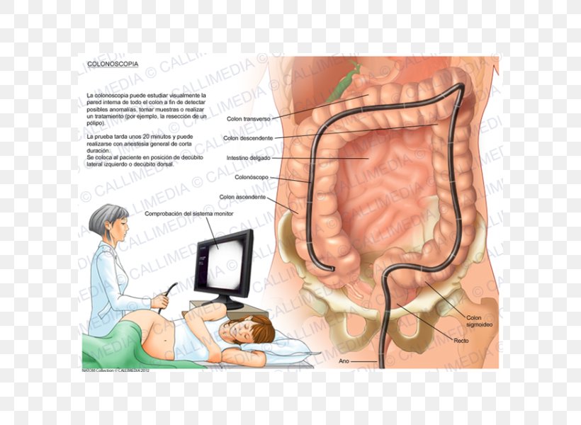 Virtual Colonoscopy Zollinger–Ellison Syndrome Diverticulosis, PNG, 600x600px, Watercolor, Cartoon, Flower, Frame, Heart Download Free
