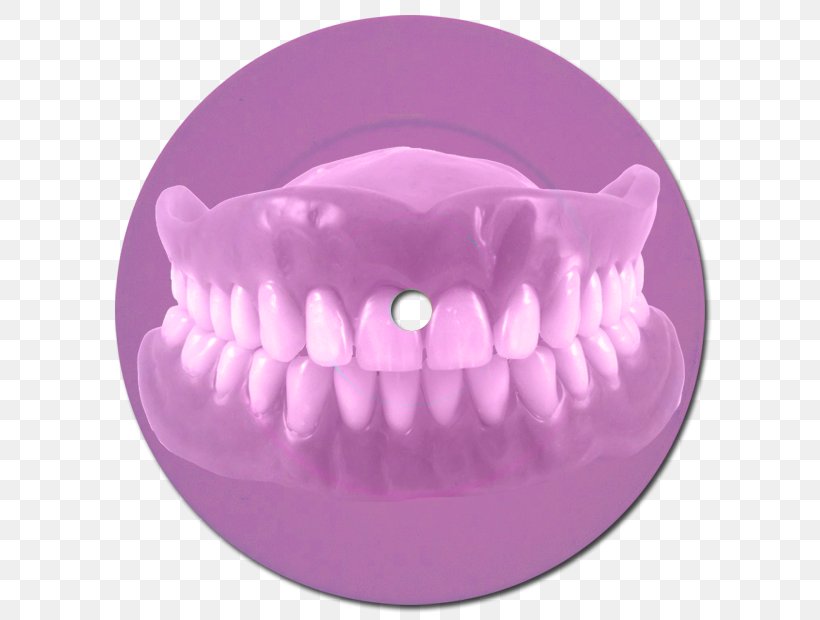 Dentures Dentistry Bridge Dental Implant, PNG, 620x620px, Dentures, Bridge, Crown, Dental Composite, Dental Implant Download Free