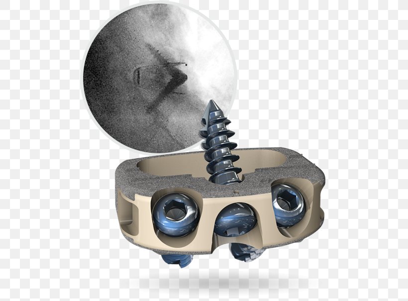 Interbody Fusion Cage PLIF Spinal Fusion Titanium Centinel Spine, PNG, 500x605px, Interbody Fusion Cage, Cervical Vertebrae, Hardware, Lumbar, Lumbar Vertebrae Download Free