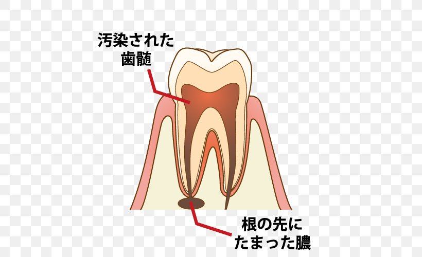 Dentist 歯科 Root Canal Tooth Decay Endodontic Therapy, PNG, 500x500px, Watercolor, Cartoon, Flower, Frame, Heart Download Free