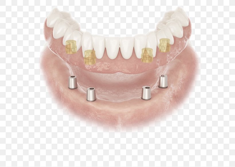 Abutment Dentures Dental Implant Dentist Edentulism, PNG, 750x581px, Abutment, Crown, Dental Implant, Dental Laboratory, Dentist Download Free