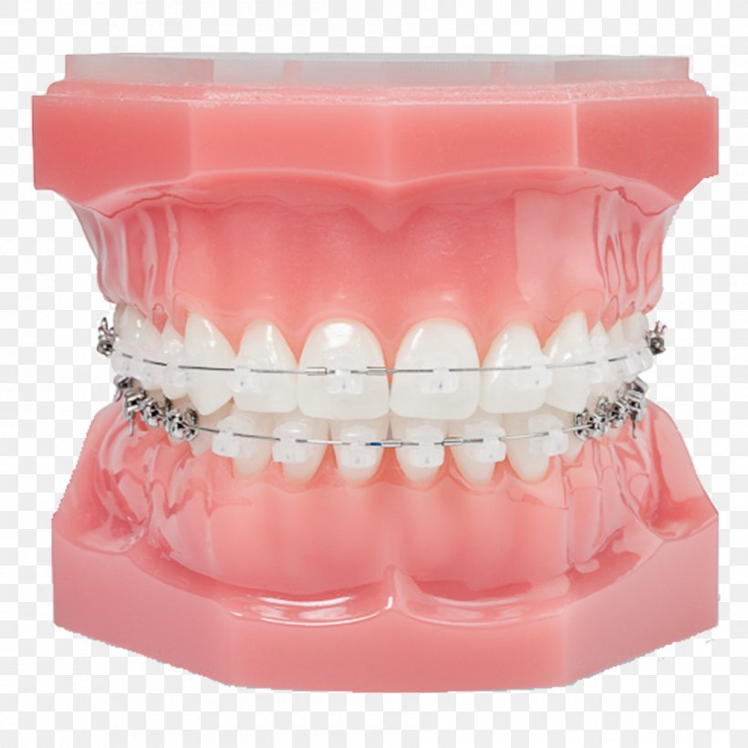 Damon System Orthodontics Dental Braces Clear Aligners Self-ligating Bracket, PNG, 1800x1800px, Damon System, Clear Aligners, Crossbite, Dental Braces, Dental Extraction Download Free