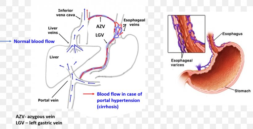 Esophageal Varices Esophagus Cirrhosis Portal Hypertension Esophageal Cancer, PNG, 1611x820px, Watercolor, Cartoon, Flower, Frame, Heart Download Free