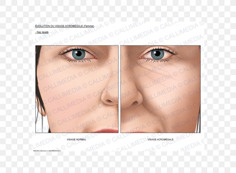 Acromegaly Nose Face Growth Hormone Endocrinology, PNG, 600x600px, Acromegaly, Blood Sugar, Cheek, Chin, Close Up Download Free