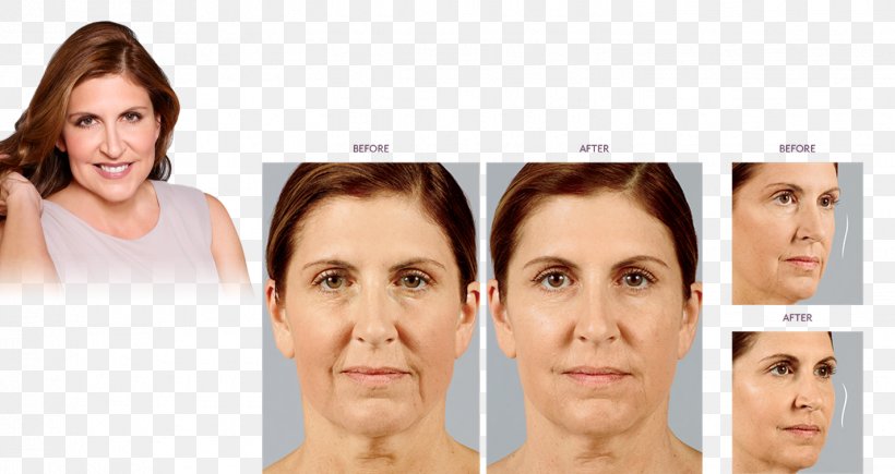 Eyebrow Injectable Filler Non-surgical Rhinoplasty Nose, PNG, 1425x757px, Eyebrow, Cheek, Chin, Cosmetics, Doctor Of Medicine Download Free