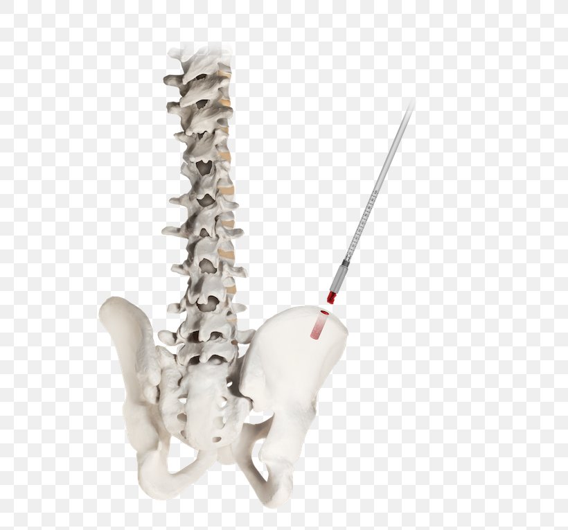 Bone Grafting Iliac Crest Bone Marrow, PNG, 600x765px, Bone, Anatomy, Bone Fracture, Bone Grafting, Bone Marrow Download Free
