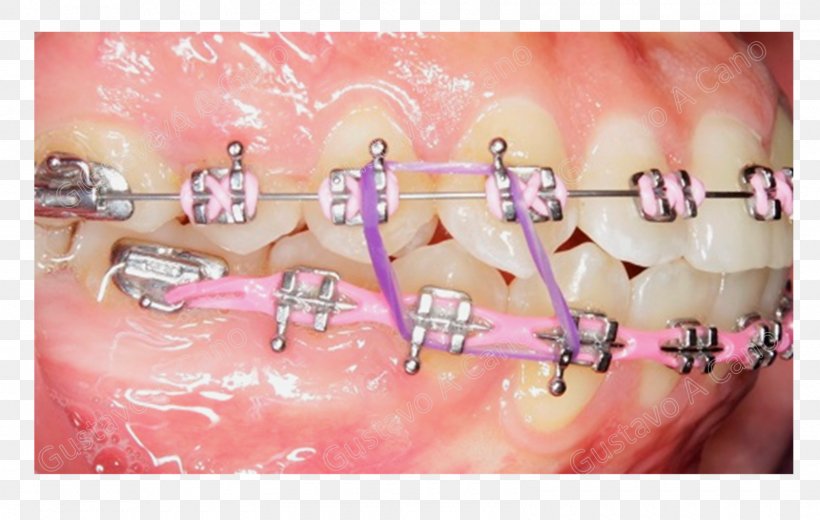 Orthodontics Dentistry Dental Braces Tooth Elasticity, PNG, 1600x1015px, Orthodontics, Blog, Box, Cheek, Chin Download Free