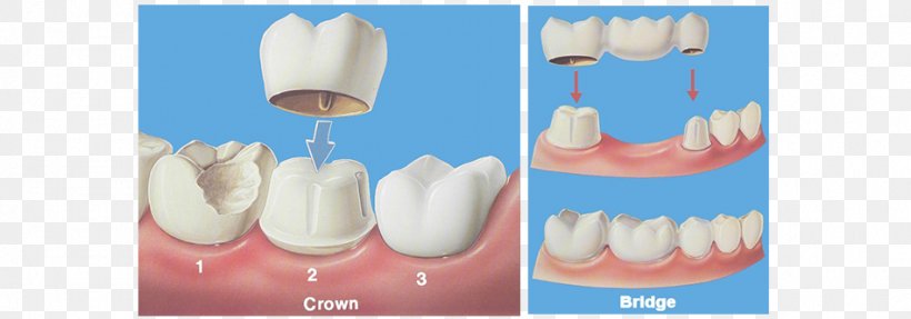 Bridge Crown Dentistry Dental Restoration, PNG, 949x333px, Bridge, Cosmetic Dentistry, Cracked Tooth Syndrome, Crown, Dental Cement Download Free