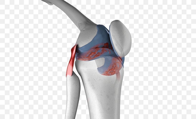 Knee Pain Arthritic Pain Knee Arthritis Joint, PNG, 500x500px, Knee Pain, Arm, Articular Cartilage Damage, Hip, Joint Download Free