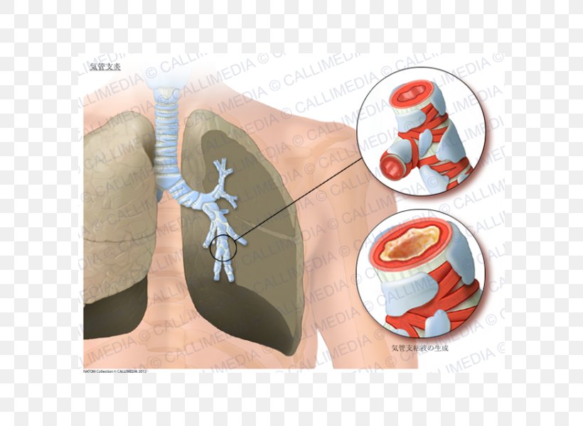 Acute Bronchitis Asthma Lung Bronchiolitis Bronchus, PNG, 600x600px, Watercolor, Cartoon, Flower, Frame, Heart Download Free