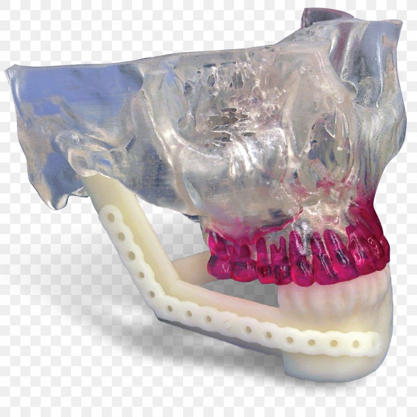 Mandible Jaw Mandibular Reconstruction Maxilla Surgery, PNG, 940x940px, 3d Systems, 3d Systems Gmbh, Mandible, Implant, Jaw Download Free