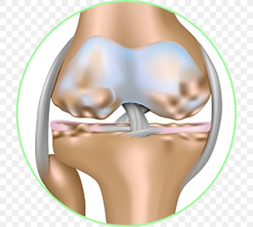 Osteoarthritis Joint Effusion Knee Effusion, PNG, 715x736px, Watercolor, Cartoon, Flower, Frame, Heart Download Free