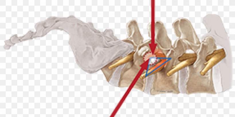 Vertebral Column Surgery Spinal Disc Herniation Endoscopy Intervertebral Foramen, PNG, 1000x500px, Watercolor, Cartoon, Flower, Frame, Heart Download Free