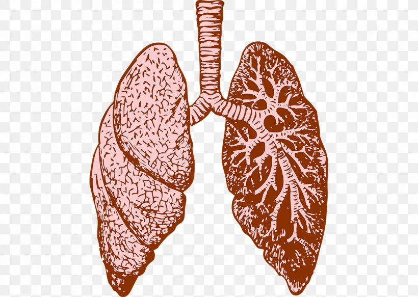 Lung Cystic Fibrosis Idiopathic Pulmonary Fibrosis Therapy, PNG, 1000x711px, Lung, Butterfly, Cystic Fibrosis, Disease, Fibrosis Download Free