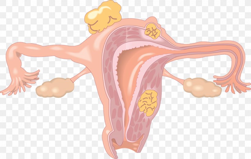 Ovary Uterine Fibroid Uterus Hormone Replacement Therapy Gynaecology, PNG, 1170x742px, Watercolor, Cartoon, Flower, Frame, Heart Download Free