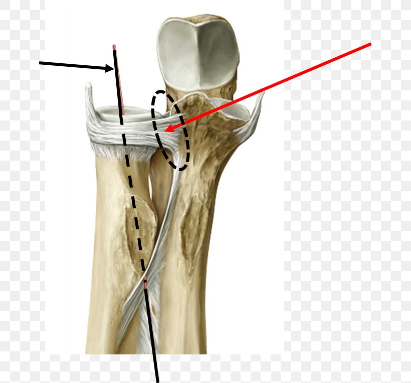 Joint Distal Radioulnar Articulation Proximal Radioulnar Articulation Ligament, PNG, 665x763px, Joint, Anatomy, Arm, Bone, Carpal Bones Download Free