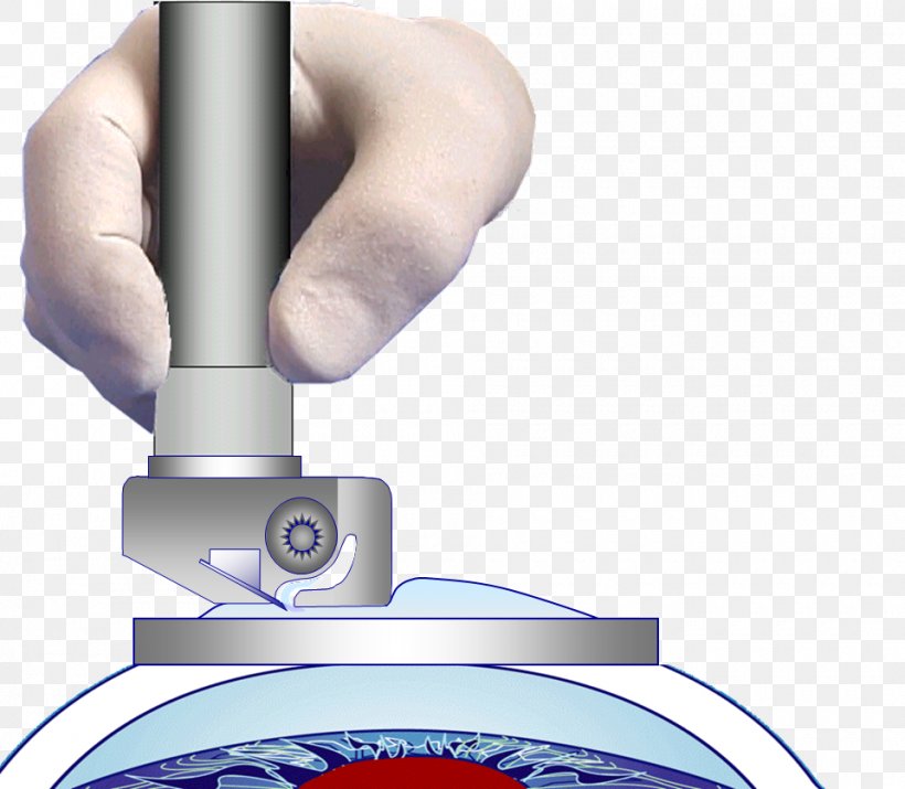 LASIK Expert Technology Experience, PNG, 960x838px, Lasik, Experience, Expert, Finger, Hand Download Free
