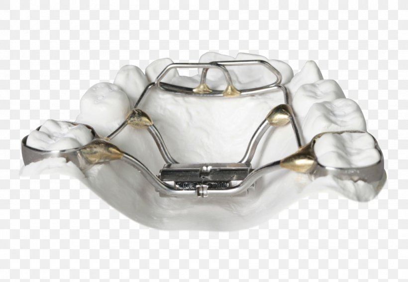 Orthodontics Palatal Expansion Cots Retainer Tongue, PNG, 1024x708px, Orthodontics, Bionator, Body Jewelry, Clear Aligners, Cots Download Free