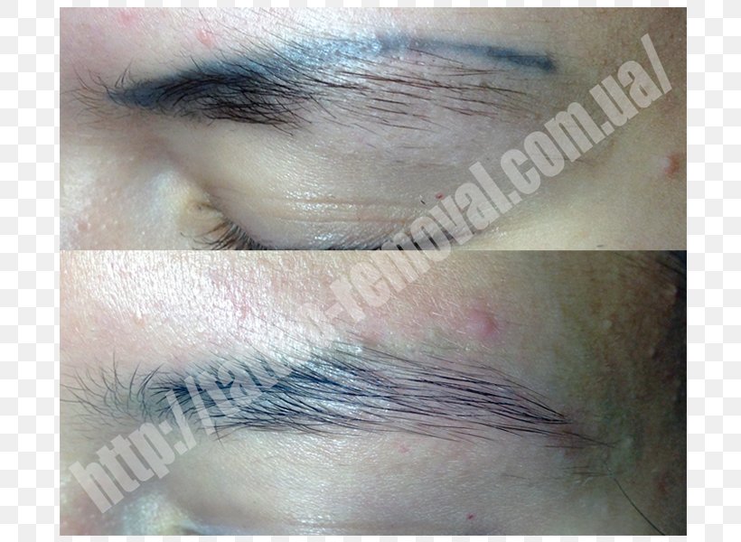 Tattoo Removal Permanent Makeup Scar Laser, PNG, 800x600px, Tattoo, Artificial Hair Integrations, Close Up, Cosmetics, Eye Download Free