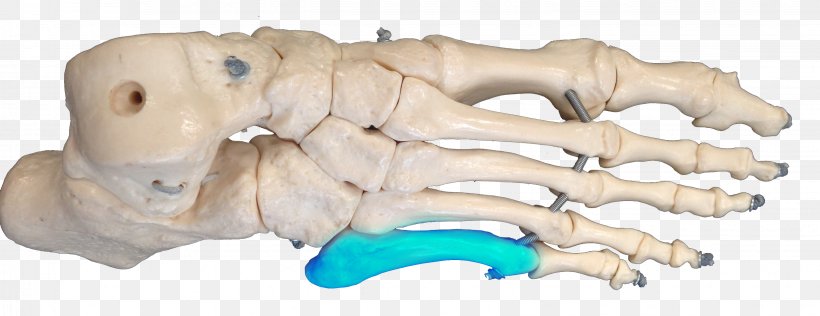 Jones Fracture Bone Fracture Metatarsal Bones Carolina Panthers Joint, PNG, 3264x1259px, Bone Fracture, Animal, Animal Figure, Bone, Carolina Panthers Download Free