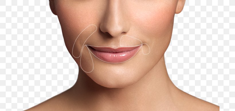 Lip Augmentation Restylane Wrinkle Botulinum Toxin, PNG, 713x388px, Lip, Beauty, Botulinum Toxin, Cheek, Chin Download Free