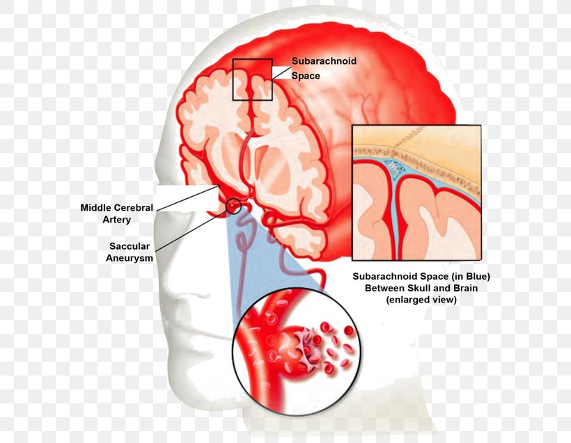 Blood Vessel Stroke Bleeding Brain, PNG, 600x637px, Watercolor, Cartoon, Flower, Frame, Heart Download Free