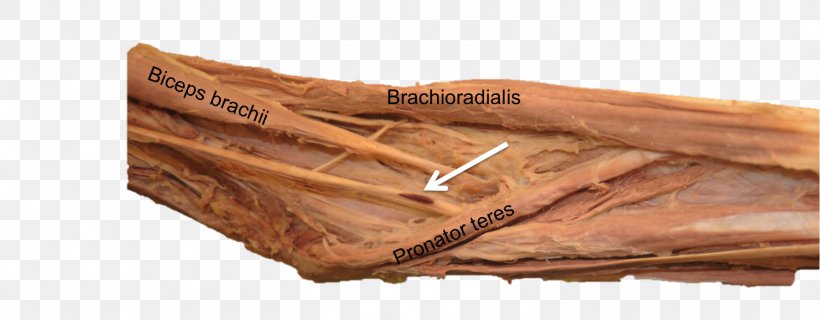 Paralysis Nerve Electromyoneurography ResearchGate GmbH Electromyography, PNG, 1501x587px, Paralysis, Diagram, Electromyography, Injection, Nerve Download Free